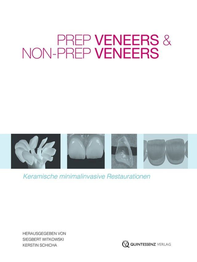  Prep Veneers und Non-Prep Veneers(Kobo/電子書)