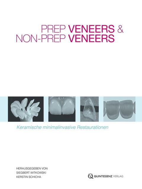 Prep Veneers und Non-Prep Veneers(Kobo/電子書)