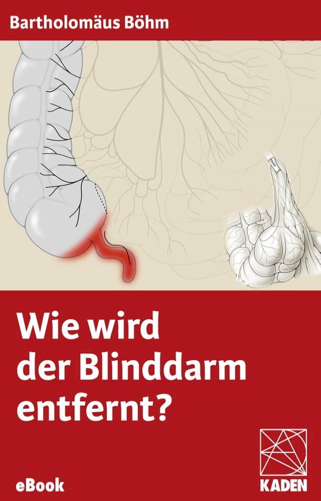  Wie wird der Blinddarm entfernt?(Kobo/電子書)