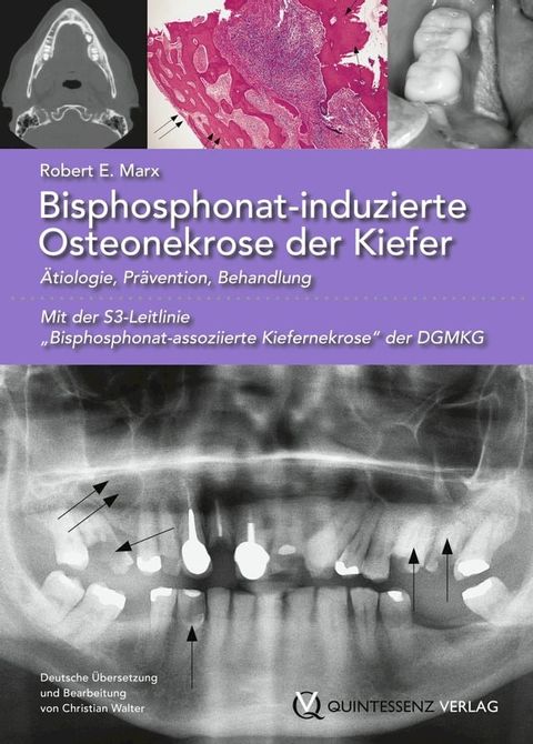 Bisphosphonat-induzierte Osteonekrose der Kiefer(Kobo/電子書)