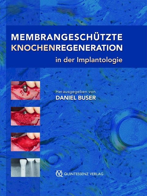 Membrangesch&uuml;tzte Knochenregeneration in der Implantologie(Kobo/電子書)