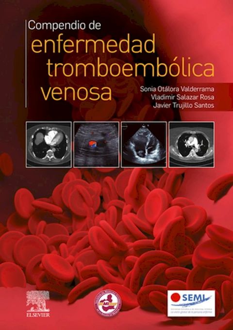 Compendio de enfermedad tromboemb&oacute;lica venosa(Kobo/電子書)