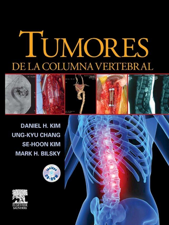  Tumores de la columna vertebral(Kobo/電子書)