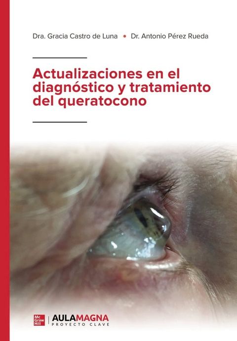 Actualizaciones en el diagnóstico y tratamiento del queratocono(Kobo/電子書)