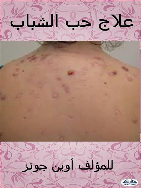 علاج حب الشباب
