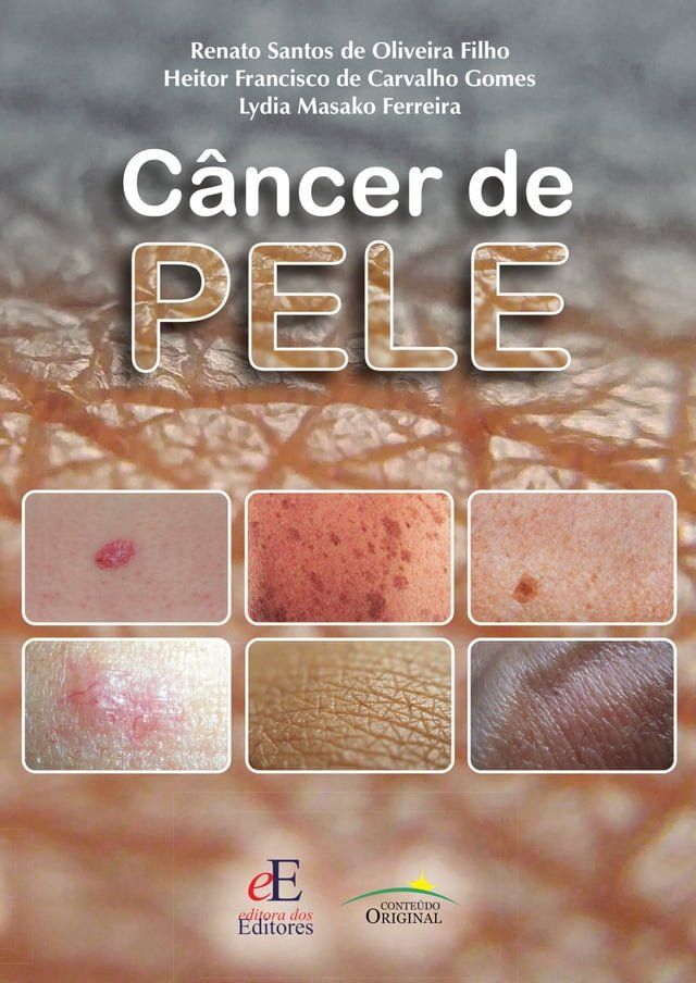  Câncer de pele(Kobo/電子書)