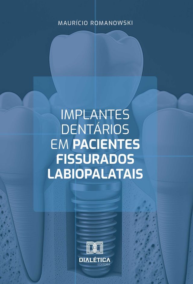  Implantes dent&aacute;rios em pacientes fissurados labiopalatais(Kobo/電子書)