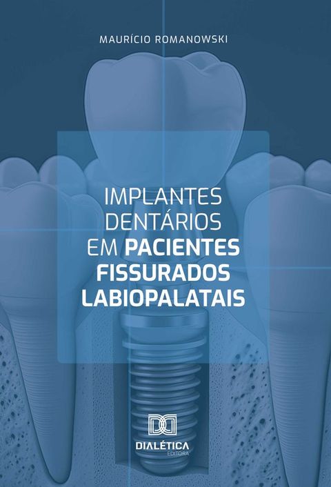 Implantes dent&aacute;rios em pacientes fissurados labiopalatais(Kobo/電子書)