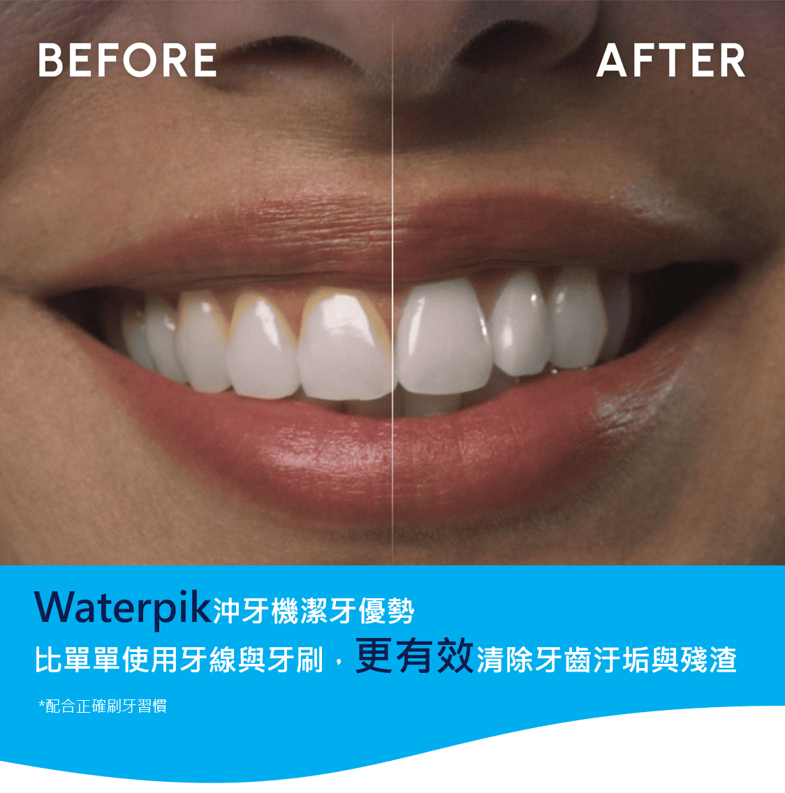 BEFOREAFTERWaterpik沖牙機潔牙優勢比單單使用牙線與牙刷,更有效清除牙齒汙垢與殘渣*配合正確刷牙習慣