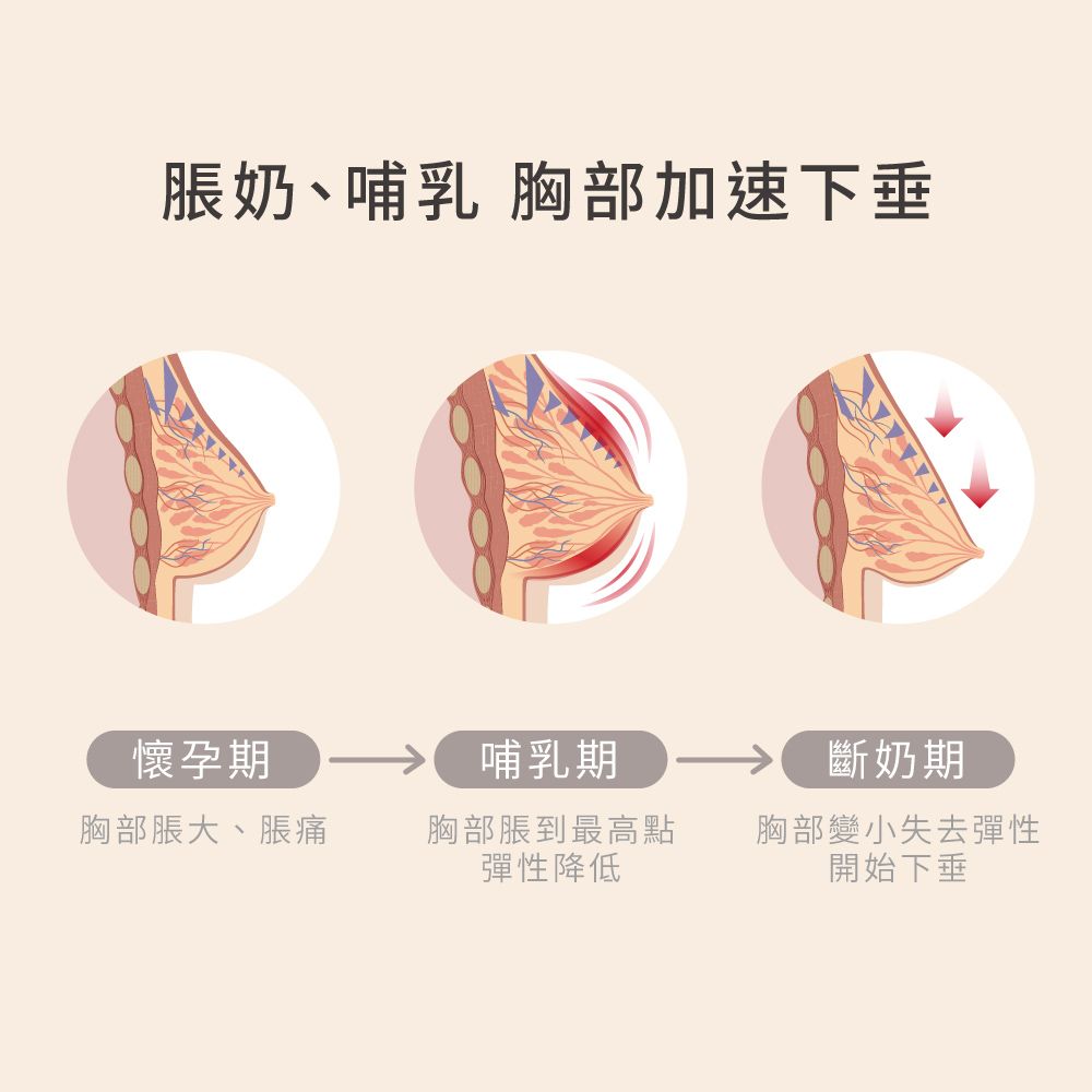 脹奶、哺乳胸部加速下垂懷孕期 哺乳期斷奶期胸部脹大、脹痛胸部脹到最高點彈性降低胸部變小失去彈性開始下垂