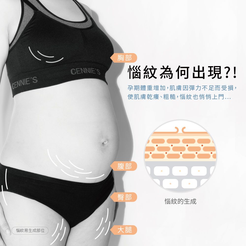 CENNIESCENNIES胸部惱紋為何出現?!孕期體重增加,肌膚因彈力不足而受損,使肌膚乾癢、粗糙,惱紋也悄悄上門...腹部臀部惱紋的生成惱紋易生成部位大腿